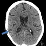 PML Mimicking Stroke in Newly Diagnosed HIV Patient
