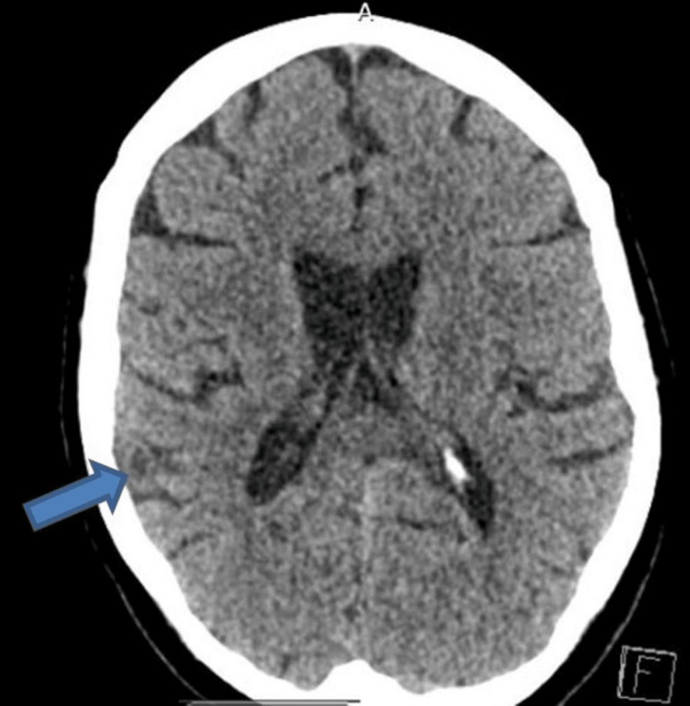 PML Mimicking Stroke in Newly Diagnosed HIV Patient